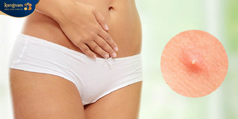 Vệ sinh vùng kín sạch sẽ, thực hiện thói quen sinh hoạt lành mạnh