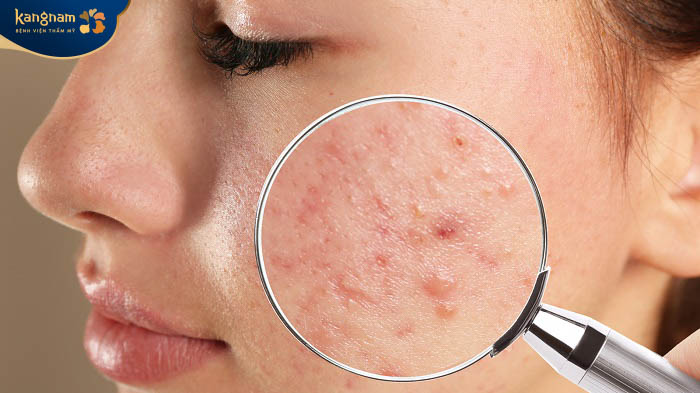 Mụn trứng cá là một trong những loại mụn thường gặp