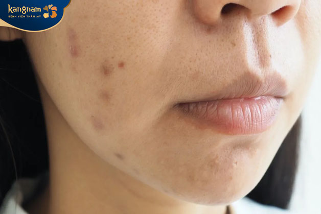 Nặn mụn sai cách có thể gây tổn thương đến làn da mỏng manh