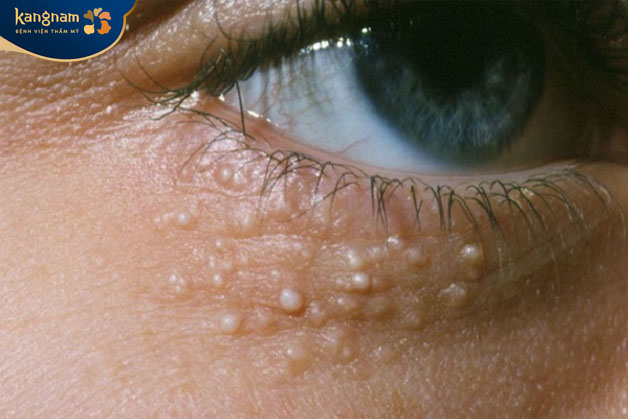 Mụn mọc quanh mắt