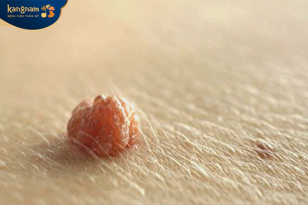 Nguyên nhân gián tiếp