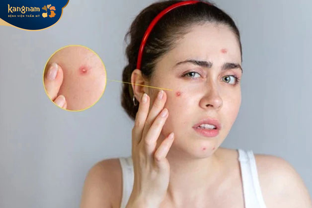 Mụn mủ có nên nặn không? Nguyên nhân hình thành mụn mủ