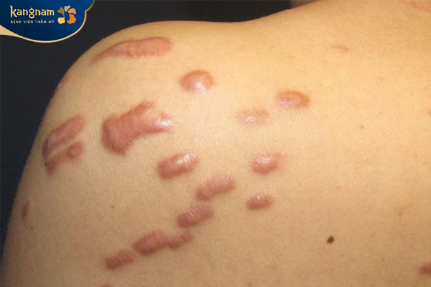 Quá trình phục hồi da sau khi điều trị mụn không đúng cách