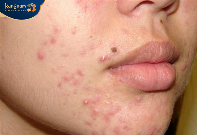 mụn trứng cá có mủ trắng hoặc vàng xuất hiện do sự tắc nghẽn của tuyến bã nhờn