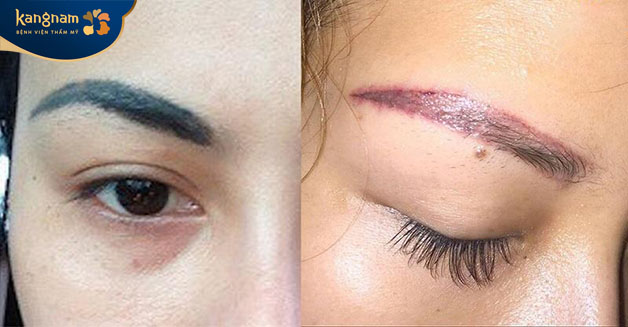 Chân mày phun theo công nghệ cũ chuyển sang màu xanh hoặc đỏ cần phải xóa đi dặm lại 