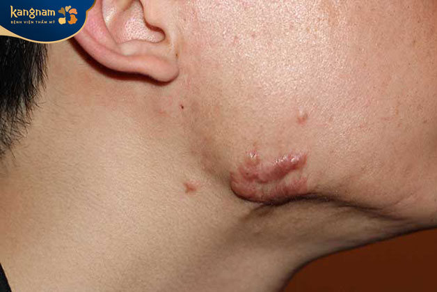 Sẹo lồi thực tế là kết quả của quá trình tổn thương