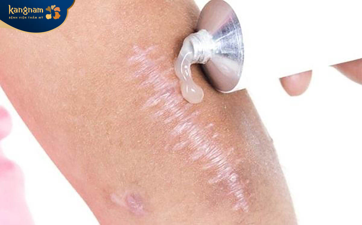 Thuốc bôi không thể khắc phục hết hoàn toàn tình trạng sẹo lồi