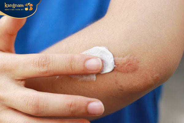 Những trường hợp sẹo lồi lan rộng dùng thuốc bôi không mang lại hiệu quả