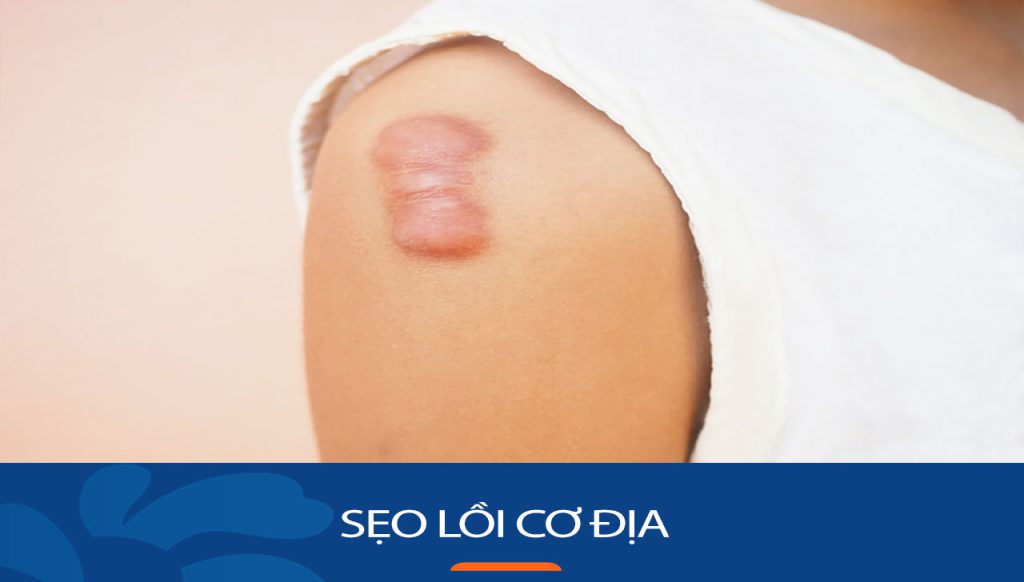 Sẹo lồi cơ địa: Nguyên nhân, triệu chứng và cách điều trị hiệu quả