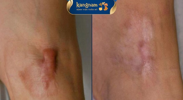 Bạn V.T.T chia sẻ sau khi trị seo lồi công nghệ ELLA