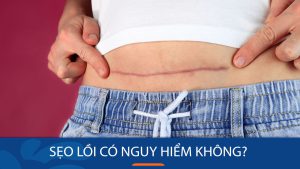 Sẹo lồi có nguy hiểm không? Bí quyết đánh bay sẹo lồi tận gốc