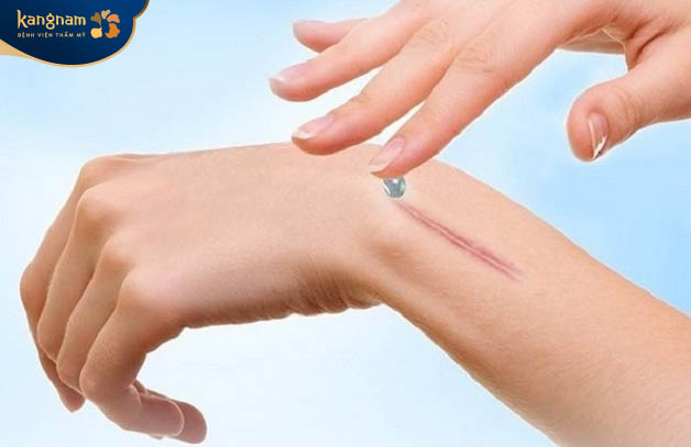 Sử dụng kem làm mờ sẹo lồi