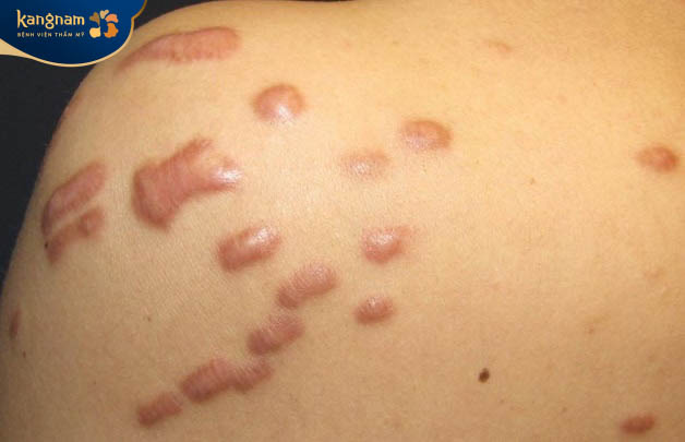 Sẹo lồi không tự hết được