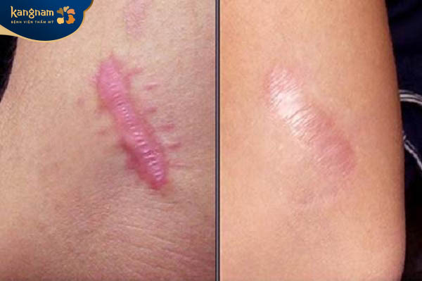 Sẹo lồi lâu năm có trị được không - Câu trả lời là có nhưng không đạt hiệu quả tuyệt đối