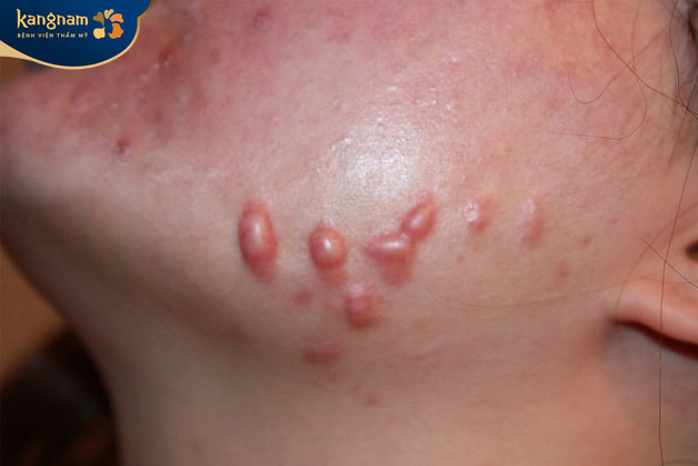 sẹo lồi do mụn để lại thường có dạng lồi lên trên bề mặt da, màu đỏ, hồng