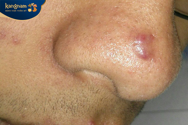 Vết mụn cũ dần dần căng bóng chuyển sang màu nâu của sẹo 