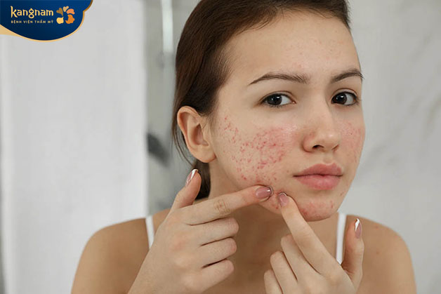 Nặn mụn khi cồi chưa chín cũng khiến sẹo hình thành 