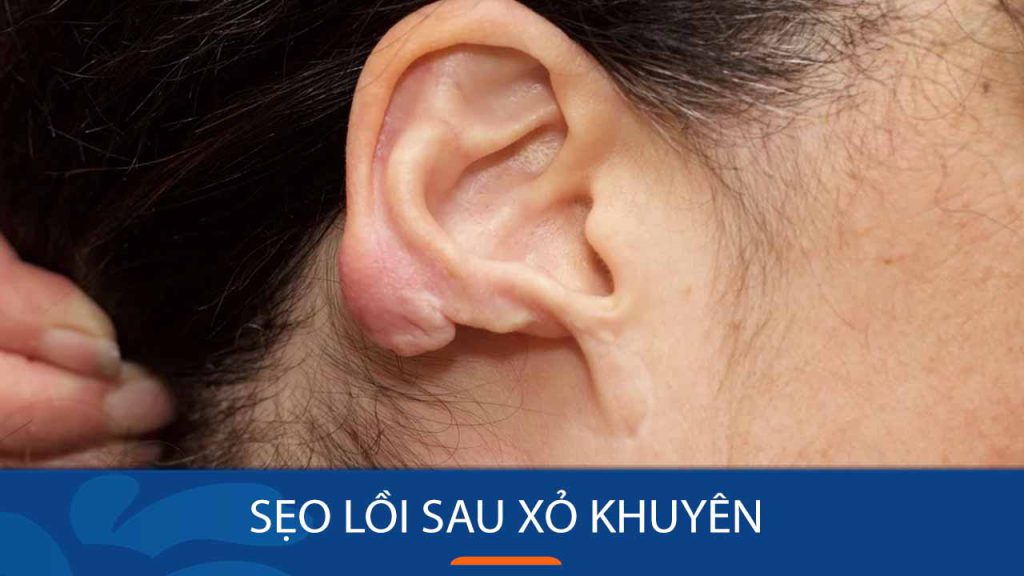 Bí quyết đánh bay sẹo lồi do xỏ khuyên nhanh chóng và an toàn