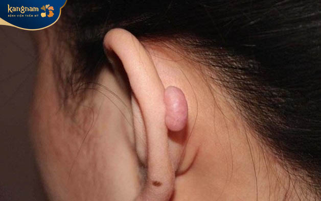 Sẹo lồi hình thành sau xỏ khuyên mức độ trung bình