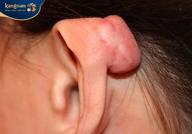 Sẹo lồi kích thước lớn sau xỏ khuyên