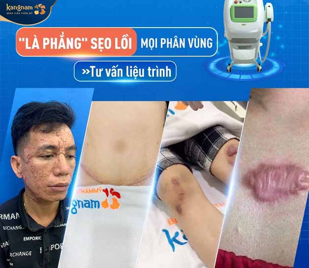 Công nghệ ELLA trị sẹo lồi tân tiến nhất trên thị trường