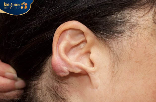 Sẹo lồi xỏ khuyên là gì?