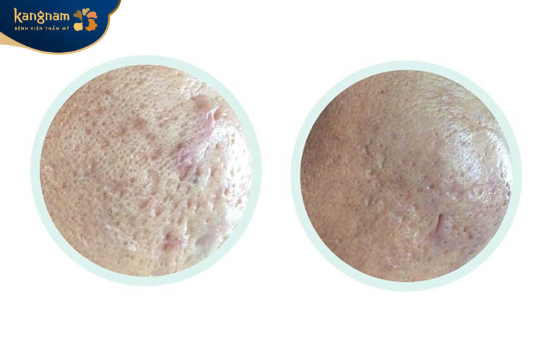 Sẹo lõm có điều trị được không - câu trả lời là có thể nhưng không khỏi hết 100%