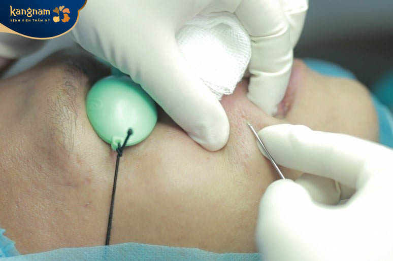 Công nghệ bóc tách đáy sẹo