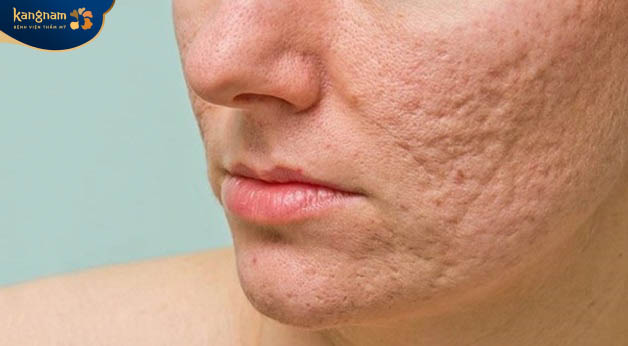 Khi mới hình thành, sẹo rỗ không thể tự đầy được