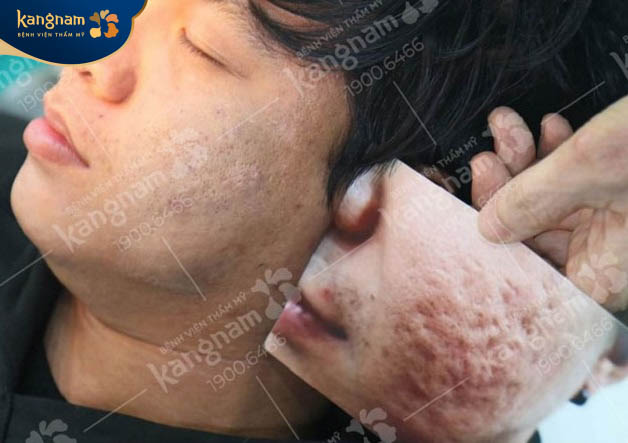 Khách hàng bị sẹo rỗ nặng đã được điều trị tại Kangnam