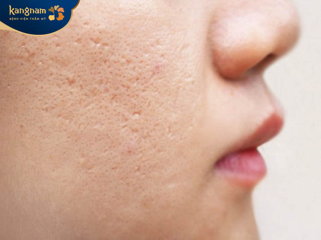 Sẹo rỗ mới hình thành là gì?