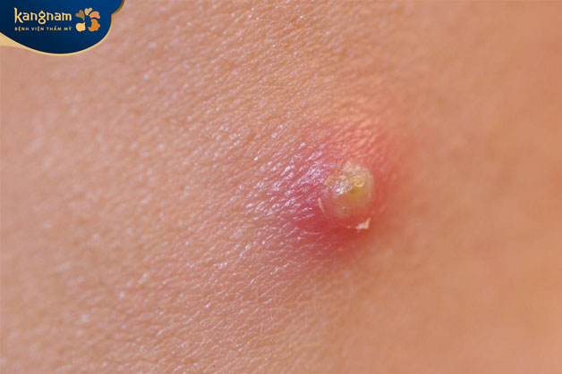 Mụn mủ có đặc điểm là các nốt sưng đỏ, màu vàng hoặc trắng