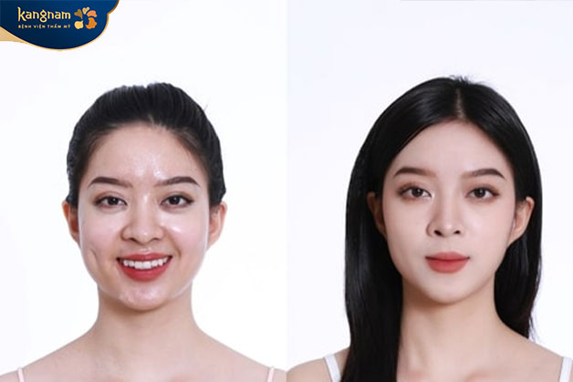 Tiêm chất làm đầy rãnh môi má có thể duy trì từ 6 - 36 tháng