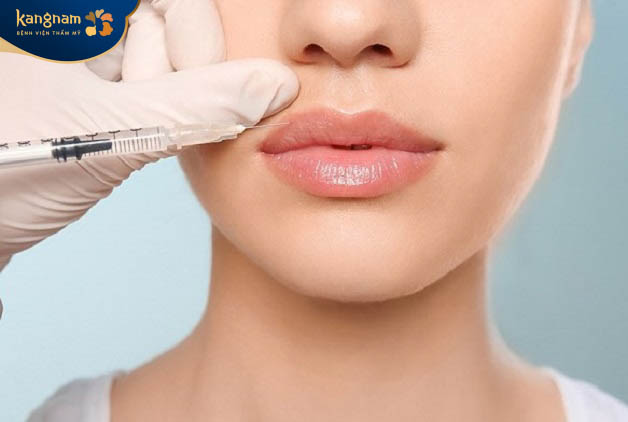 Tiêm filler môi cười có hiệu quả không?