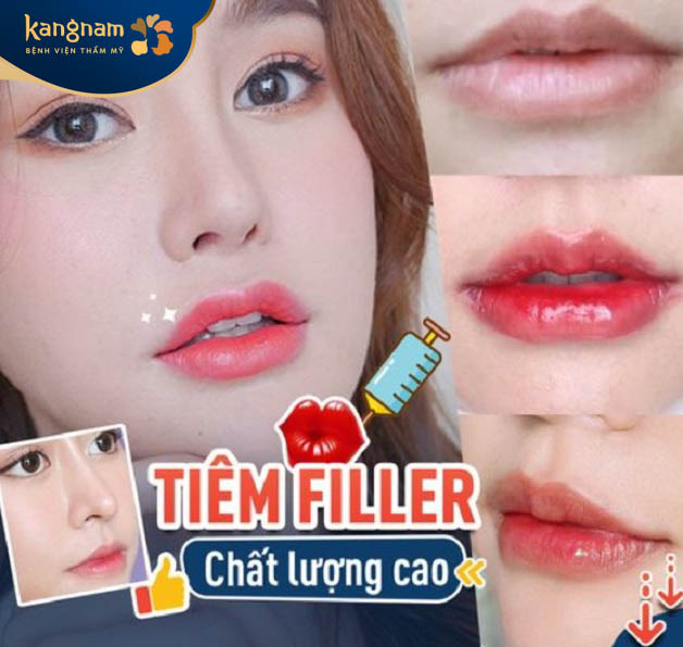 Tiêm filler môi cười tại Bệnh viện thẩm mỹ Kangnam