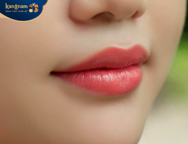 Tiêm filler dáng môi cười là gì?