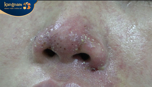 Nhiều trường hợp mũi bọ hoạt tử khi thực hiện dịch vụ tại cơ sở không uy tín