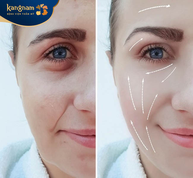 Chi phí tiêm HA xóa rãnh môi má rẻ hơn phẫu thuật