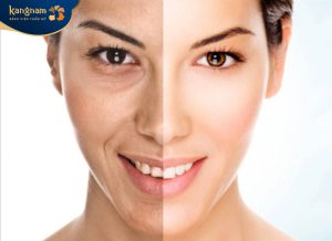 Tiêm filler rãnh cười: Nguy cơ tiềm ẩn và cách phòng ngừa