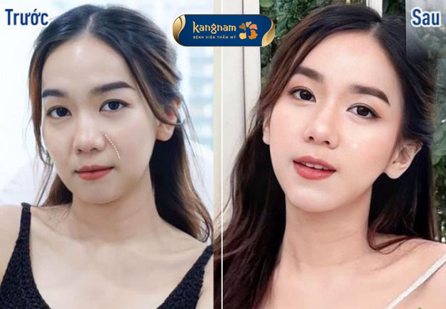 Rãnh cười được loại bỏ hoàn toàn sau tiêm filler