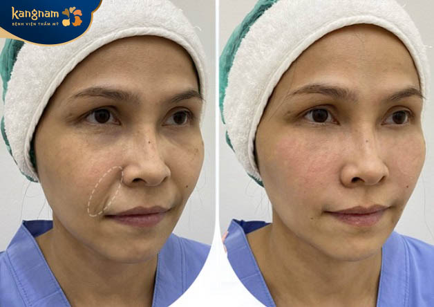 Gương mặt trẻ hóa sau tiêm filler xóa rãnh cười