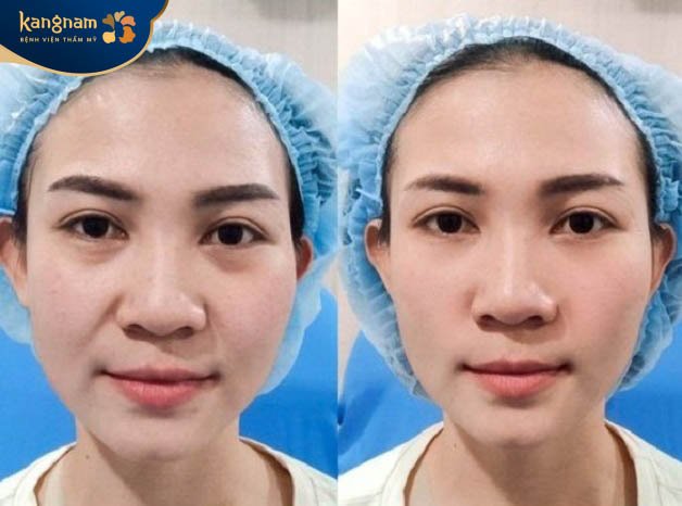 Khách hàng hài lòng với kết quả tiêm filler rãnh cười tại Kangnam