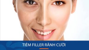 Tiêm filler rãnh cười: Bí quyết xóa mờ nếp nhăn, trẻ hóa da mặt