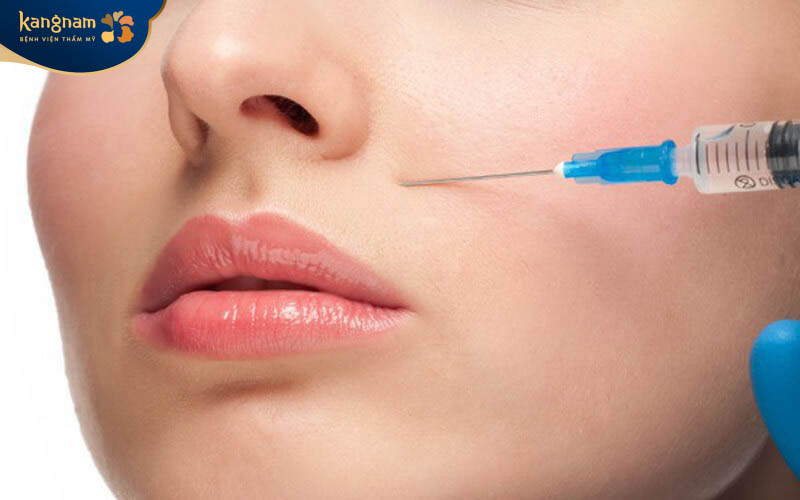 Tiêm chất làm đầy rãnh cười là phương pháp trẻ hóa hiệu quả