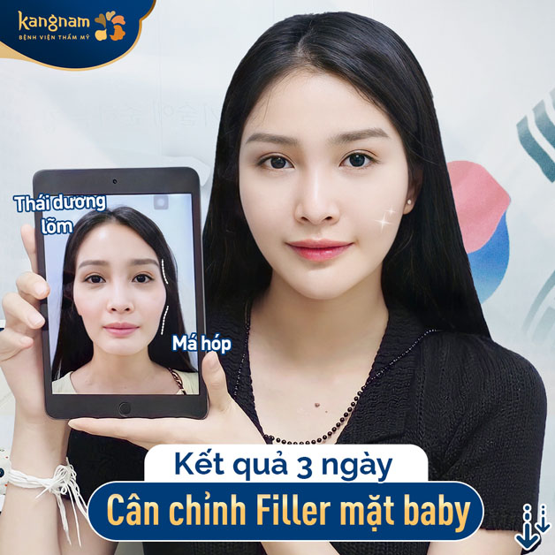Khách hàng tiêm filler tại Kangnam sau 3 ngày