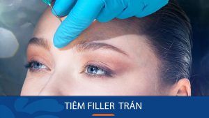 Tiêm filler trán: Bí quyết sở hữu trán đầy đặn, căng mịn trong tích tắc
