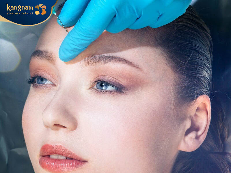Tiêm chất làm đầy trán giúp cải thiện nếp nhăn vùng trán