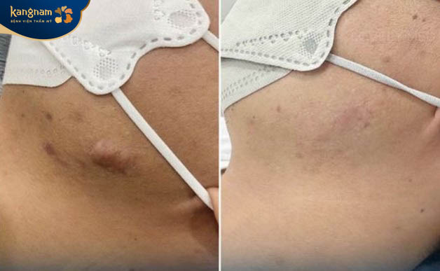 Sẹo lồi được là phẳng chỉ với 1 liệu trình