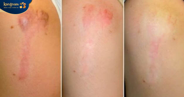 Khách hàng trị sẹo lồi tại bắp tay