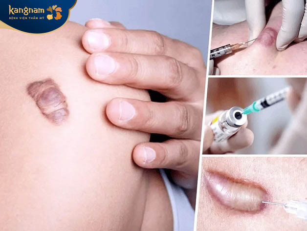 Tiêm sẹo lồi có nguy hiểm không?